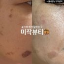 강남반점 | 강남 역삼역 기미 흑자 제거 밀크반점 제거 후기 | 미작뷰티 강남본점
