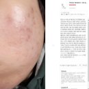 505 | 화제의 방송 바로 그 제품! 오발리신 여드름화장품 닥터505 리얼후기