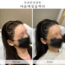 마음에점을찍다두피SMP 이미지
