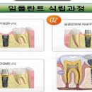 오스템임플란트--중국성장, 국내시장도 의료보헙 적용확대로 성장 이미지