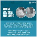 부분매복사랑니 주의사항은요 이미지