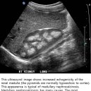 Medullary Nephrocalcinosis 이미지