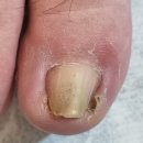 진영메디칼 | 김해 진영 내성발톱 심한 파고드는 발톱도 개선되는 닥터페디 김해진영점