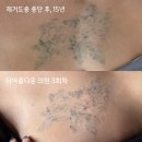 아름다운의원 - 광진구 능동로 127 | 문신제거 3회차 후기 통증관리 더아름다운의원