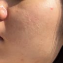 정*균 - 안양시 만안구 | 예비신부 피부관리로 찾은 창원에스테틱, 정아하다 정아크네케어 후기