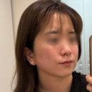 압구정본산부인과의원 | 압구정 아르나의원 세르프600샷 내돈내산 찐후기(울써마지 효과?)