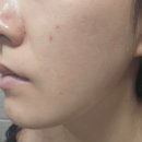 목동역뷰티 콜드플라 쟈민뷰티 흉터케어 리얼후기 보여드려요