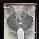 명성의원 | 광명방사선과의원 나팔관 조영술 자세한 후기｜양쪽 나팔관 막힘｜복막염