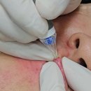 두려움을 제거하는 가장 빠른 방법 | 입술하얀점 포다이스반 제거하는 방법 공개