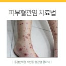 피부 붉은반점 혹시 혈관염일까 원인과 증상에 대한 정리 이미지