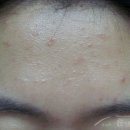 윤앤송한의원 | [좁쌀여드름, 화이트헤드]윤앤송한의원, 좁쌀여드름 피지선파괴침 시술 후기 입니다.