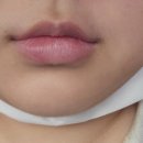 봉의원 | [내돈내산] 르에이치의원 입술필러 후기