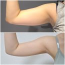 팔뚝 지방추출주사 vs 지방흡입 차이 (5주차 예신 찐후기)