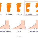 맨발 걷기 운동을 해서는 안 되는 사람 이미지