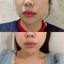 (주)강남 | 강남역피부과 울쎄라 수면마취없이 받은 솔직후기