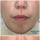 스타메디컬 | [수원 윤곽관리] 5회 만에 돌출입 윤곽관리 후기사진 팔자주름채우기! 알테온 컨투어링 🔥
