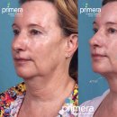 강남-245 | 울쎄라 써마지 — 원리·효과·차이 완전 비교