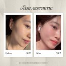 (주)원광미트라인 | 청주신부관리 추천 | 리미에스테틱 7월 이벤트 & 볼패임고민 고주파 관리 후기