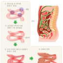 참좋은연세외과 | 260209 김토끼 일기_간이식 공여자 합병증 / 장유착이 뭐죠...?