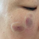 윤혜진피부샵 | 15년 함께한 흑자와 이별하기! 흑자 제거 리팟레이저 은평 피부과 후기