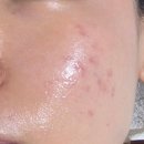 보람한의원 | 대구여드름흉터치료 추천 로담한의원 대구점 패인 흉터치료 내돈내산 한의원 피부과 대구새살침 치료...