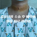 🌿갑상선암 수술 직접 경험 후기