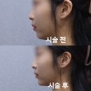맑고고운의원 - 양천구 목동서로 35 | [용인] 동백역 근처 안아픈 무턱 , 짧은 턱 필러 내돈내산 후기