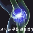 쑤시고 아픈 무릎 관절염 탈출법 이미지