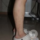 해율한의원 | 팔 다리가 가려워 긁어서 생긴 색소침착에 "율각테라피" 치료 후기입니다 - 대구 해율한의원