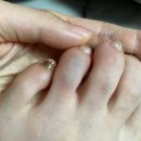 맑은샘센텀병원 | 인천 네번째 발가락골절 ? 후기