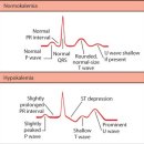 Hypokalemia 이미지