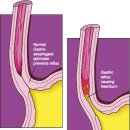 Oesophagitis: Indigestion and Heartburn 이미지