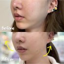송피부과의원 | 동탄실리프팅 솔직 후기, 민트실로 되찾은 V라인! 효과 유지기간 및 가격 멍 붓기 부작용은?