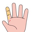 재건약국 | 칼에 손이 찔렸을 때 손가락 감각저하 신경봉합술 신경재건술 병원 수술 입원 비용 후기