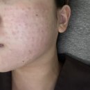 디데이 호텔 | [디데이의원] 서면 피부과 내돈내산 추천 쥬베룩 리쥬란 스킨보톡스 후기 / 남포동 피부과 추천 모공...