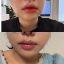 예뻐지는의원 | 바노바기의원 창원 레스틸렌 V라인 턱필러 내돈내산 솔직후기