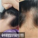 양정1동-10 | 부산탈모성지로 알려진 원탈모클리닉에서 유아원형탈모 3회 받고 느낀 변화 내돈내산