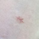 삼성고운맥외과의원 | 강서구 발산역 삼성고운맥외과 피지낭종 , 피부섬유종 제거 수술후기 비용(가격)