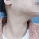 안산지루성피부염 회복을 위해 피부과 선택 및 한의원 내원 시 치료 비용과 가격 책정 기준