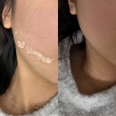 300 | 천안 불당동 피부과 텐트리플300 후기 일주일 변화 과정