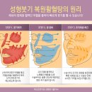 Re:복부랑 허벅지 지흡후 붓기요.(피브로한의원 답변입니다.) 이미지