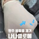 나나테라피 | 원주비립종 안아프게 제거 잘하는 곳 무실동 나나클로에 솔직 후기