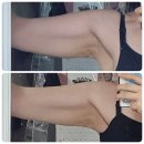 다이어트 후 늘어진 팔뚝 바디온다 리얼후기 청담 바디관리 재방문