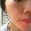 [내돈내산] 얼굴 편평 사마귀 CO2 레이저 제거 후기 (세종 블리비 의원) &amp; 닥터덤 재생테이프 후기