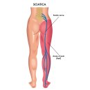 좌골신경통(Sciatica)의 이해 이미지