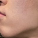 잇츠미의원 | [천안/신부]잇츠미 의원 레이저 제모 내돈내산 후기 전후 사진