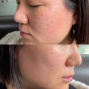 강남역 한의원에서 편평사마귀 레이저 치료 후기