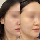 삼일메디텍 | 신논현역성형외과 셀터미 리바이브엔 효과 통증 등 2주간의 찐후기