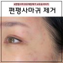 나을한의원 | [강남] 편평사마귀 무제한 레이저 제거 후기! HPV치료 성지 한의원 다녀왔어요~