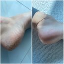 풋스올경기 | 발굳은살제거 고양발관리 원탑 화정풋스올에서 관리후기